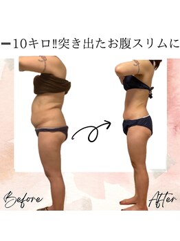 サロン ド ボーテ ラーンジュ 岐阜店(salon de beaut'e L'ange)/ハイパ-ナイフEX2ダイエット痩身