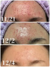 アズ(AZU)/●before after