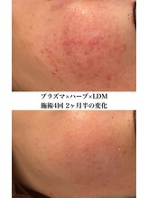 リラ(Lilas) ハーブ ピーリング