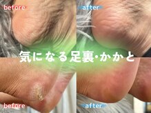 爪のいろはの雰囲気（サンダルの季節到！あなたは明日サンダル履けますか？？）