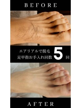 エアリアル 南行橋店/足の指脱毛　ビフォーアフター