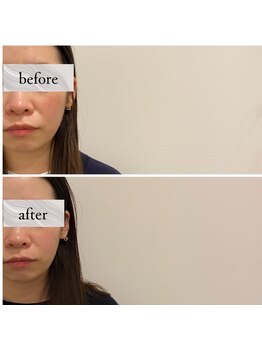 コス(KOS)/ほうれい線ビフォーアフター