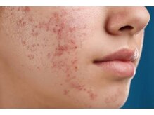 フィオーレ/小鼻の黒ずみ クスミ &nbsp;乾燥肌