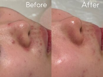 カレンジェビューティー(CarengeBeauty)/プラチナクレイピール