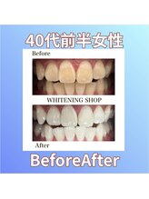 ホワイトニングショップ 西原店/40代前半女性☆BeforeAfter