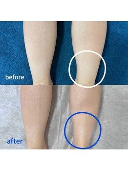 ベアスキン(BARESKIN)/フットケアのビフォーアフター