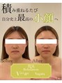 ヴィヴィアン 太田川店(Vivian)&nbsp;【小顔コルギ】エラ解し5回目の変化