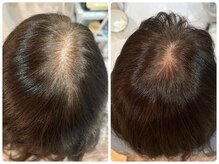 気になる頭皮のお悩みにエクソソーム療法で髪の再生をサポート