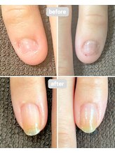 カピリナ(Ka Pilina)/自爪育成・深爪・川崎