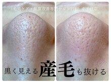 ピエル 北千住店(PIEL)/黒く見える産毛も抜ける