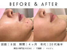 ロエヴェ(ROEWE)/ニキビ改善・毛穴ケア・肌質改善