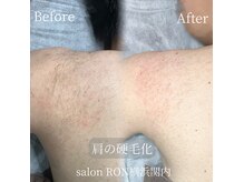 硬毛化も脱毛出来ます！お任せ下さい！