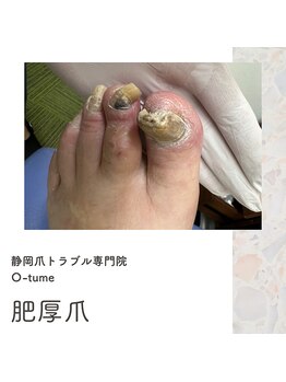 オツメ 静岡(O-tume)/肥厚爪