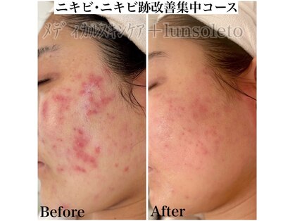 ルンソルテ(lunsoleto)の写真