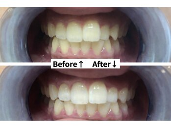 シエスタビューティラボ/プレミアムホワイトニング