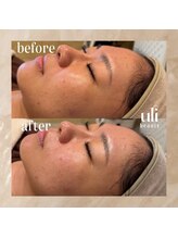 ウリ(uli beauty)/比較写真