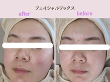 まつげや いちじくの雰囲気（フェイシャルワックス/うぶ毛除去、毛穴ケア、トーンアップ◎）