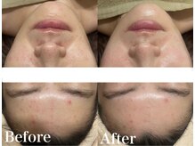 マスカレード(Masquerade)/【クリスティーナ症例写真】