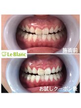 ルブラン 奈良店(Le Blanc)/お口の小さいかたでも
