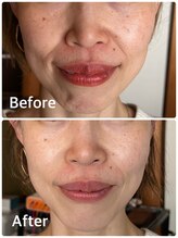 ハリキュア(Hari-Cure)/美容鍼と疲頭鍼　Before After