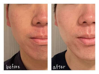 ミースプラス(me,as+)/サーマクール / 全顔1回 