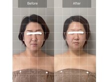 カピリナ(ka pilina)/脳洗浄一回での変化です