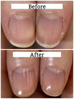 ハンドケア◇施術前後