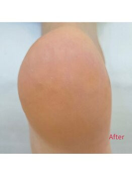 レフス 北参道店(REFUSS)/本格角質ケア