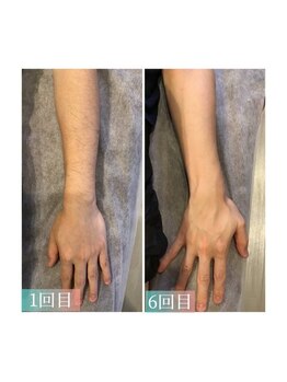 メンズ脱毛 ウィッシュ(Wish)/ヒジ下・手の甲・指　脱毛　