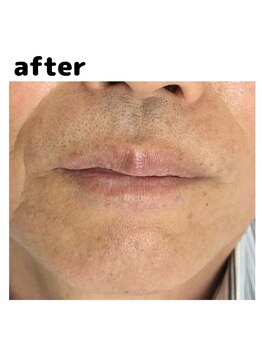 ナノハナ/ひげ脱毛