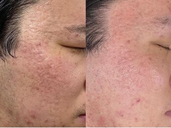 カラーズ(COLOURS)/ニキビケア/肌トラブル改善に◎