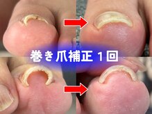 爪のいろはの雰囲気（長年の巻き爪も1回の補正でここまで変化!痛みから即解放～♪）