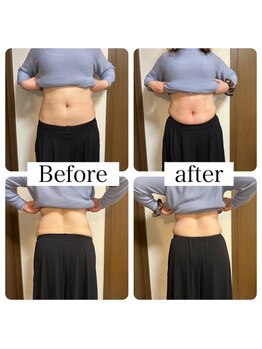 エリシオン(ELYSION)/脂肪冷却