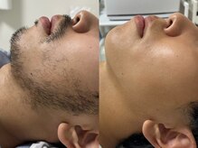 アールビューティー(R Beauty)/ヒゲ脱毛でお肌もキレイに☆