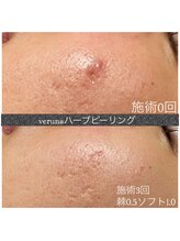 ココ 2号店(CoCo)/ハーブピーリング施術経過