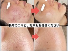 リアリア(LEALEA)の雰囲気（長年の慢性ニキビ、毛穴の開きにも◎）