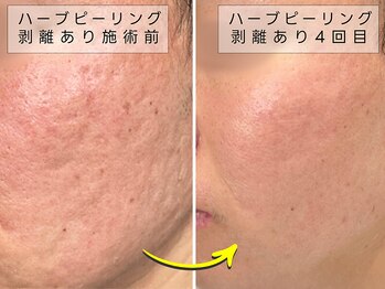 育肌美研 自由が丘サロン/肌の凸凹｜ハーブピーリング