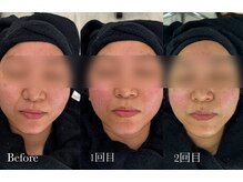 ウルト(ULT)/レモンボトルBefore after