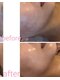 ドール(doll)の写真/剥けない！話題の《韓国ピーリング×モデリングパック》で理想のハリツヤ水光肌◆水光ジェット/毛穴洗浄