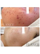 プランス 福岡(PLANCE)/毛穴ニキビケア福岡天神エステ
