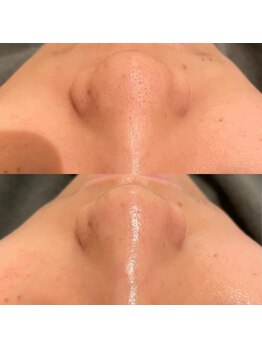 ポポラス(POPOLUS)/毛穴洗浄１回