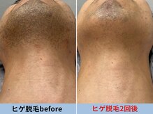 ミスターアンクール 鹿児島(Mr.uncoeur)/ヒゲ脱毛2回後