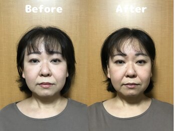 くにたちNyan鍼灸整体院/【小顔矯正】Before After 7