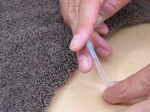 しらとりスポーツサポートマッサージ 鍼灸院 神田/つら～い腰痛/鍼灸施術/整体