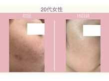 ルアナアイリー 花巻駅前店(lu'ana ily)/Eライトフェイシャル症例