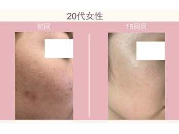 ルアナアイリー 花巻駅前店(lu'ana ily)/Eライトフェイシャル症例