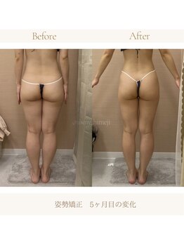 アスミー/ハップル 姫路店(Asmy/happle)/姿勢矯正継続5ヶ月目の変化