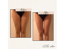 ヴィアス(VIAS)の雰囲気（インディバ温熱で見た目にも変化が◎）