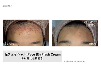 ドルチェビューティーサロン 戸塚安行店(Dolce Beauty Salon)/プラズマ光Facial_施術4回
