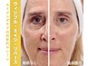 【最新エイジングケア】加齢によるほうれい線/しわ・たるみ/くすみ緩和即実感